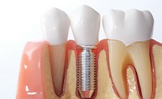 Shiny model dental implant