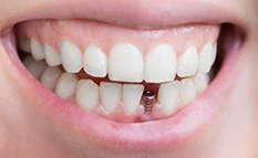 Closeup of a dental implant