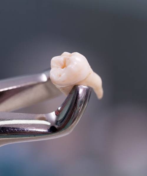 Close up of forceps holding an extracted tooth