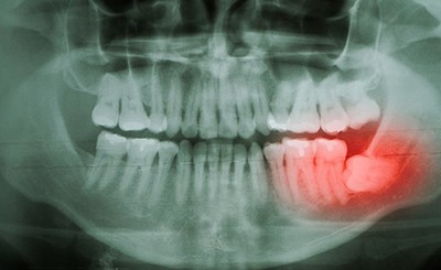 Dental X-ray highlighting an impacted wisdom tooth 