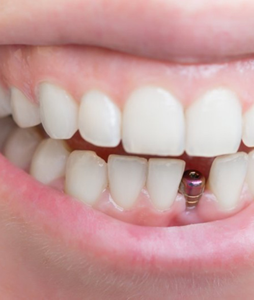 Close up of a patient’s implant