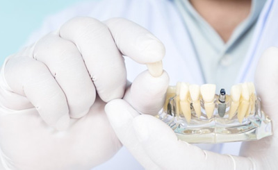 Dentist holding the crown of a dental implant model