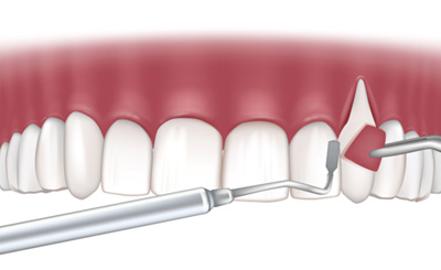a 3D illustration of gum grafting surgery