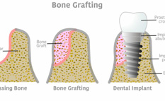 Illustrated diagram of a dental bone graft