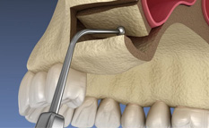 Illustration of dental instrument lift the sinus