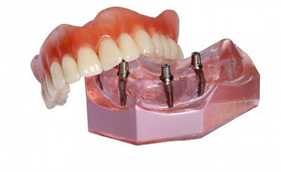 Model of All-on-4 dental implants and denture
