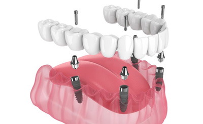 Exploded illustration of All-on-4 implants