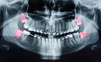 An X-ray of a jaw with wisdom teeth