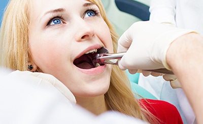 A woman getting her wisdom teeth extracted