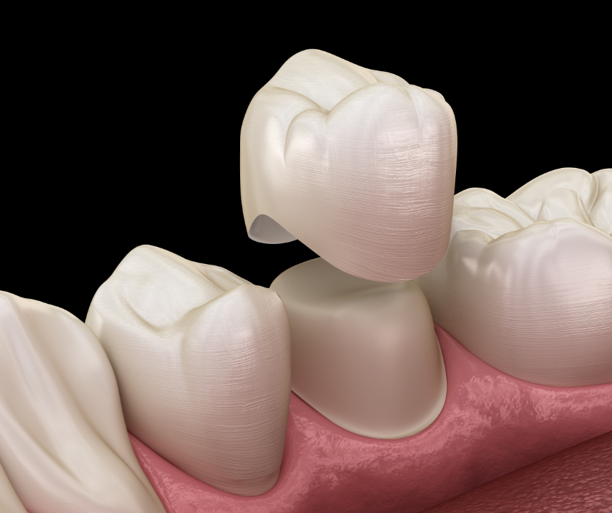 3D image of a dental crown