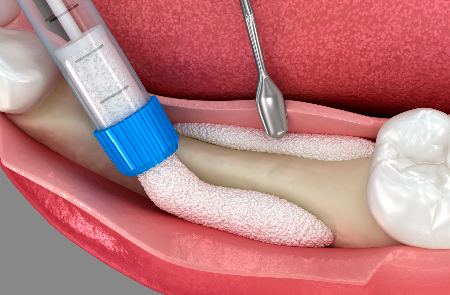 3D image of a gum graft