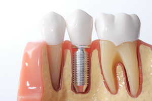Model of a dental implant between two teeth.